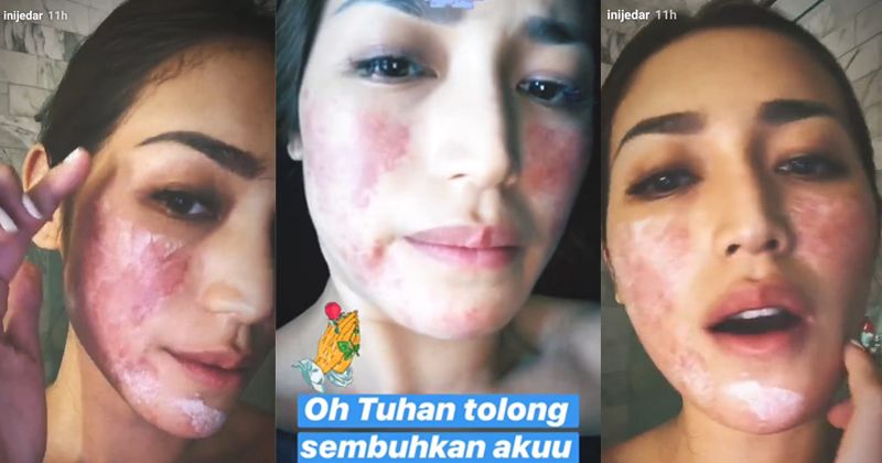 Alami Ruam Merah-merah, Wajah Jessica Iskandar Kenapa?