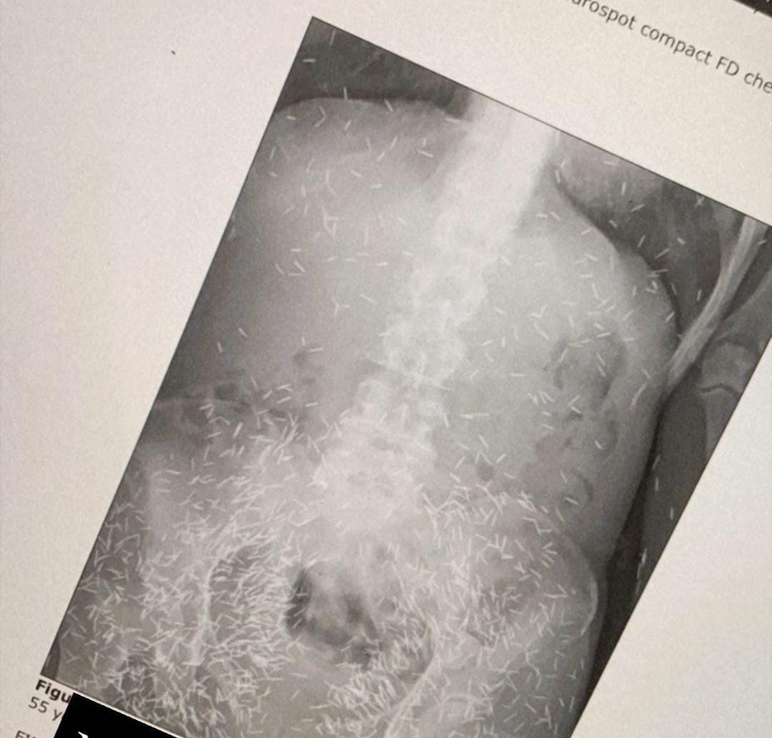 Heboh Ratusan Jarum Diduga 'Susuk' Tertangkap X-ray di Tubuh Pasien Berusia 55 Tahun 