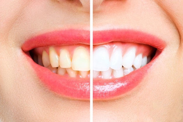 5 Bahan Alami Rumahan untuk Memutihkan Gigi
