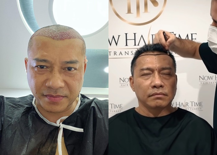 Mengenal Transplantasi Rambut yang Dilakukan Anang dan Biayanya