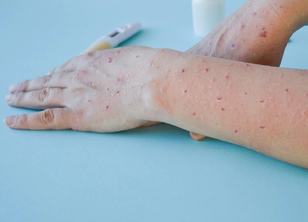 Vaksin Cacar Dinilai Efektif Kurangi Risiko Tertular Monkeypox